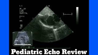 Complete AV Canal Dextrocardia Levotransposition of the Great Arteries LTGA [upl. by Atnoved996]