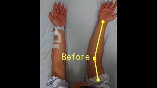 Elbow valgus deformitycubitus valgus surgery by Dr Ahn [upl. by Monjan]