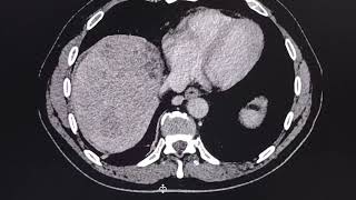 Acute liver  hepatic  failure CT findings [upl. by Colwen976]