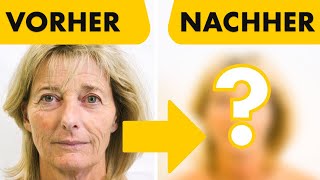 Facelift OP mit Halsstraffung VORHER  NACHHER Ergebnis 50jährige Patientin  Dr Walther Jungwirth [upl. by Aicxela420]