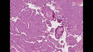 Histopathology Thyroid Papillary carcinoma [upl. by Aeirdna]