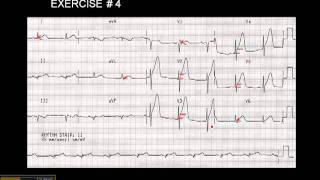 1215 Lead ECG Exercise  4 [upl. by Quar]