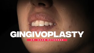 Gingivoplasty 2  Dr Kaan Öztoprak [upl. by Seiden978]