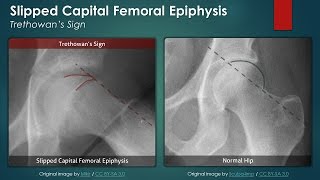 Slipped Capital Femoral Epiphysis Plain Radiography [upl. by Stephine]