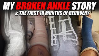 My Broken Ankle Story Trimaleollar Fracture [upl. by Aldwin822]