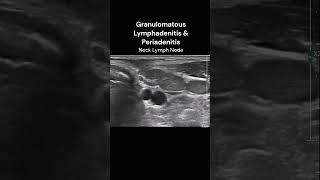 Neck Lymph Nodes  4 ultrasound imaging infection inflammation cases [upl. by Lithea248]