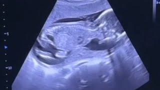 ultrasound of baby moving in womb [upl. by Eitsrik]