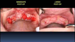 MANDIBULAR IMPLANT OVERDENTURE FABRICATION [upl. by Chaunce514]