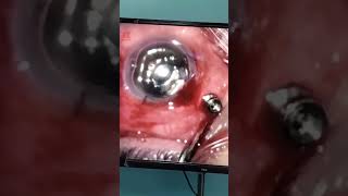 Vitrectomy Closing hospital ent doctor squint unfrezzmyaccount squinttreatment [upl. by Hescock]