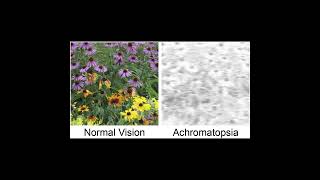 Achromatopsia Symptoms and Causes  Diagnosis  Treatment  Prevention healthcare [upl. by Lyrahc704]