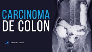 Carcinoma de Colon 👩🏻‍⚕️ Consultorio Medico [upl. by Worth]