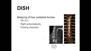 Basics Diffuse Idiopathic Skeletal Hyperostosis DISH Spine 서경진 [upl. by Teodor615]