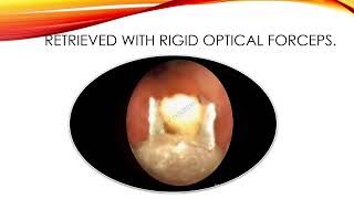 Corn 🌽 Seed In Paediatric Airway  Rigid Bronchoscopic Intervention [upl. by Parrisch505]