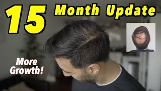 15 Month 2nd Hair Transplant Update  4000 GRAFTS FUE  MORE GROWTH [upl. by Barnett]