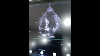 This view conclusion doctor echocardiography echocardiographer life pregnant baby doctorupdat [upl. by Lacefield]