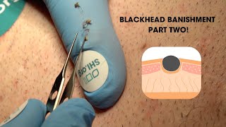 Blackhead Banishment Part Two Super Satisfying Blackhead Squeeze [upl. by Ahsetal]