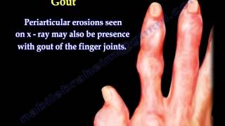 Arthritis Of The Fingers types and patterns  Everything You Need To Know  Dr Nabil Ebraheim [upl. by Ecirrehs]