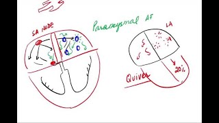 Atrial Fibrillation  Pathophysiology and Clinical [upl. by Nnuahs]