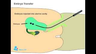 Embryo Transfer procedure [upl. by Sew]