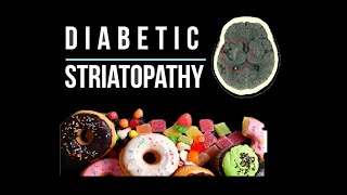 Diabetic striatopathy Nonketotic hyperglycemic hemichorea [upl. by Urson75]