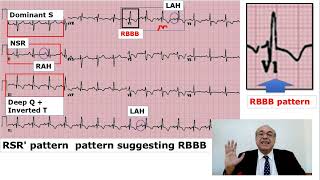 EKG Trainer Case 2 Answer CME internalmedicine ecg محاضراتباطنة امراضباطنة [upl. by Yorgen]