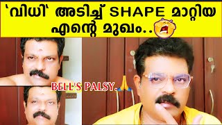 വിധി അടിച്ച് shape മാറ്റിയ എൻ്റെ മുഖം  BELLS PALSY  Actor ManojKumar [upl. by Donaghue]