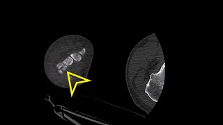 Wrist CT Hook of Hamate Fracture [upl. by Notlad]