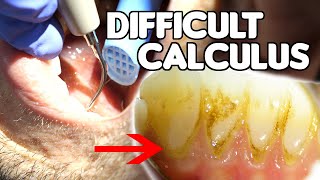 How To Remove Difficult amp Tenacious Calculus Tartar [upl. by Schweiker]