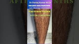 Varicose veins treatment  Result after 3 months Best varicose veins treatment for SSC GD medical [upl. by Lasley619]