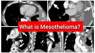 Mesothelioma of Pleura CT Chest [upl. by Noiroc]