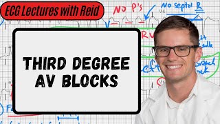 Third Degree AV Blocks  Day 7 ECG Challenge [upl. by Assital]