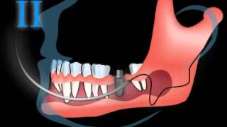Live OP wie wird ein Zahnimplantat gesetzt  Implantation [upl. by Atel]