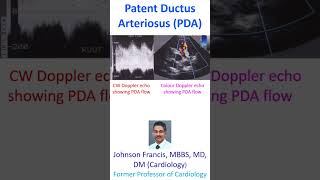 Patent Ductus Arteriosus PDA [upl. by Wessling]