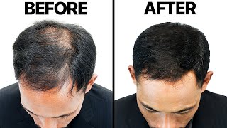 Finasteride Propecia For Hair Loss [upl. by Dev642]