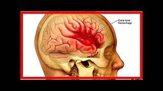 Ischemia cerebrale sintomi diagnosi e cura [upl. by Caye150]