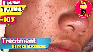 Blackhead Treatment For Young Boy 15 year old  Acne Treatment 107 [upl. by Jacob]