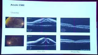 AIOC2017  Current Concepts Cystoid Macular Edema Decoded 18022017  12001325  HALL C [upl. by Acnayb]