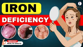 10 Weird Signs Youre Low on Iron  Iron Deficiency Anemia  Iron Deficiency Symptoms [upl. by Asha]