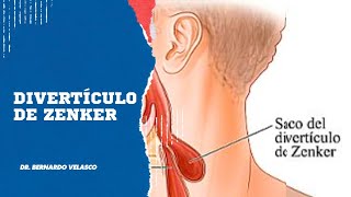 DIVERTICULO DE ZENKER Dificultad para tragar tos crónica rejurgitación de alimentos [upl. by Kary878]