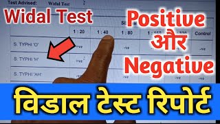 Widal Test Widal Test Positive Widal Test In Hindi Widal Test Report विडाल टेस्टWidaltestkaise [upl. by Ailbert]