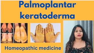 Palmoplantar keratoderma treatment  Palmoplantar keratoderma symptomscauses amp homeopathic medicine [upl. by Araeit426]