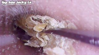 Ear Wax Removal 170 He was tormented by itchy ears every night  Ear Cleaning ASMR [upl. by Natloz]