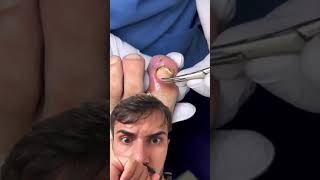 A UNHA TRANSPASSOU A PELE  ingrownhairremoval podologia unhaencravada nails foryou [upl. by Aaronson]