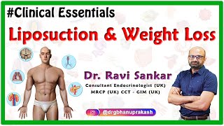 Liposuction and Weight Loss  DrRavi Sankar Endocrinologist MRCPUK CCT  GIM UK [upl. by Nibbor]