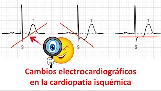 Cambios electrocardiográficos en la cardiopatía isquémica [upl. by Bonine]