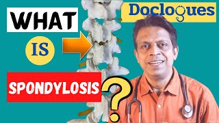 What is Spondylosis [upl. by Nirrac]