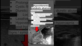 Hypochloremic metabolic alkalosis [upl. by Wennerholn]