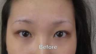 Eyebrow Transplant Amazing Results [upl. by Issej]