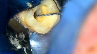 Rotary Root Canal Instrumentation with Vortex File [upl. by Tombaugh158]