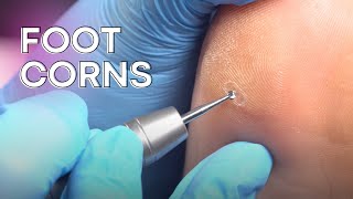 Corn removal and callus reduction  safe and easy [upl. by Annagroeg]